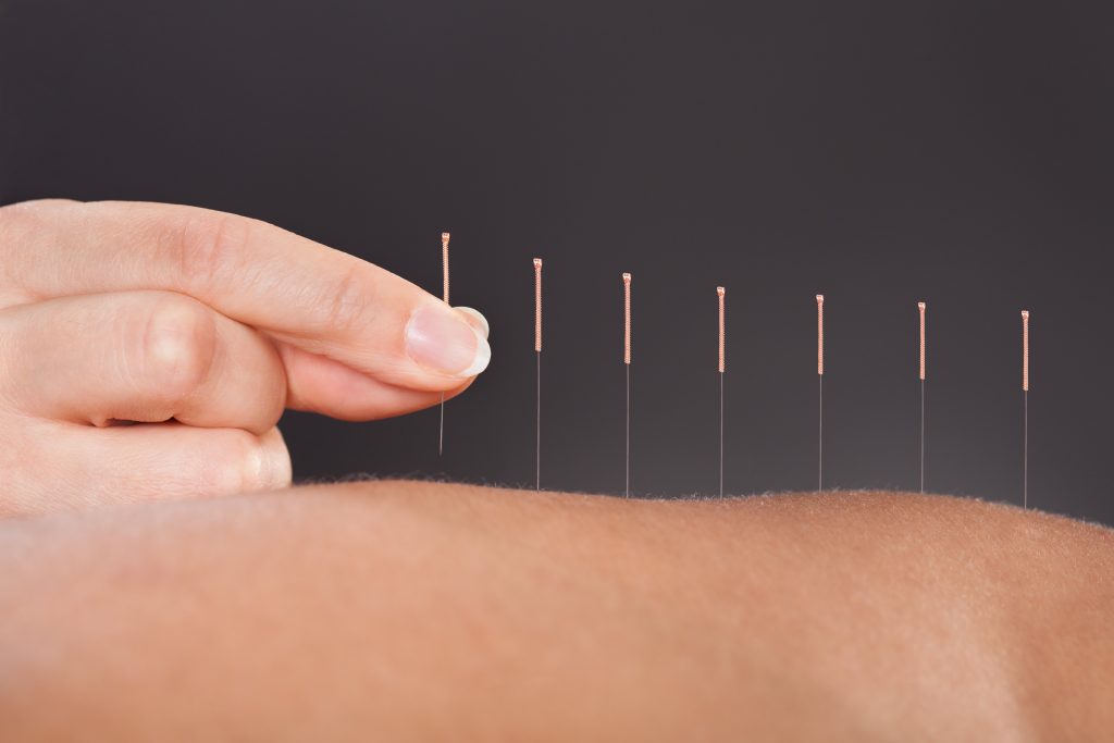 A picture of acupuncture needles being inserted through the skin