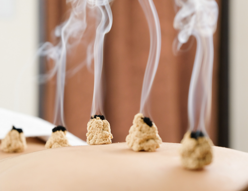 An image of moxibustion when applied directly.